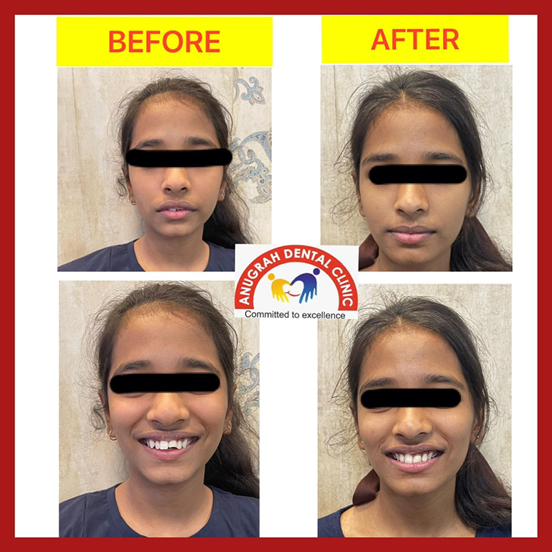 Best Orthodontist Lucknow